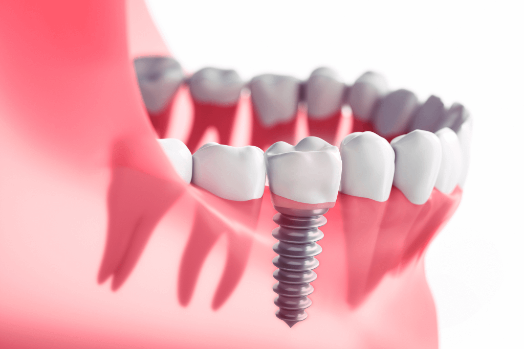Quanto tempo dura um implante dentário? - Saiba mais aqui