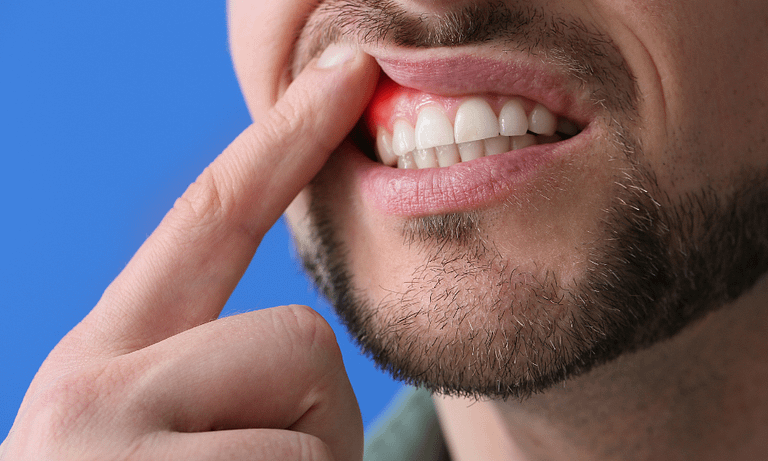 Confira no artigo o que é abscesso dentário, suas causas e tratamentos. Saiba como prevenir e manter sua saúde bucal em dia.