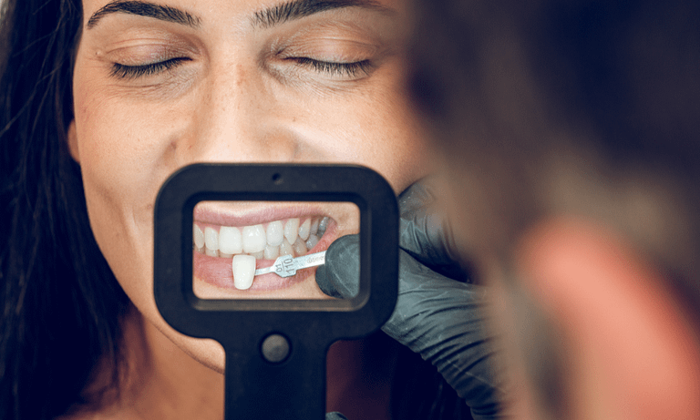 Quem tem periodontite pode colocar facetas?