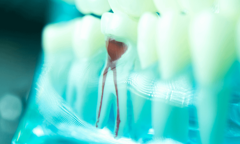Como é feito o canal no dente?
