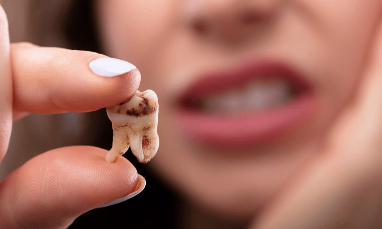 Quanto custa uma restauração de dente com cárie