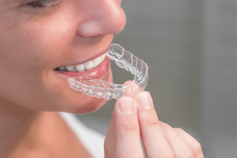 Quanto custa um alinhador dental? Descubra no artigo!