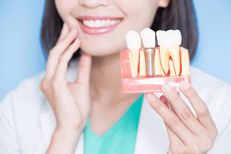 Como funciona o implante dentário - Fique por dentro de tudo do assunto e onde fazer