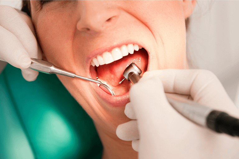 Limpeza dental clareia os dentes? Te contamos aqui, confira